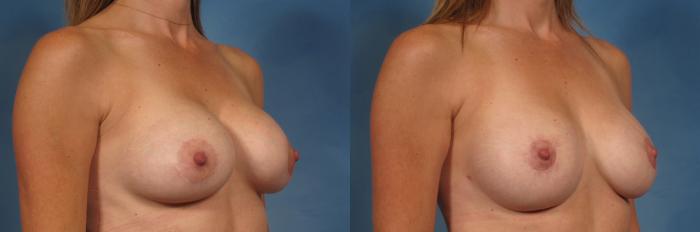 Before & After Breast Lift Case 200 View #4 View in Naples and Ft. Myers, FL