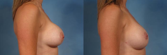 Before & After Breast Lift Case 200 View #5 View in Naples and Ft. Myers, FL