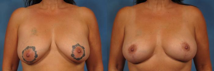 Before & After Breast Lift Case 239 View #1 View in Naples and Ft. Myers, FL