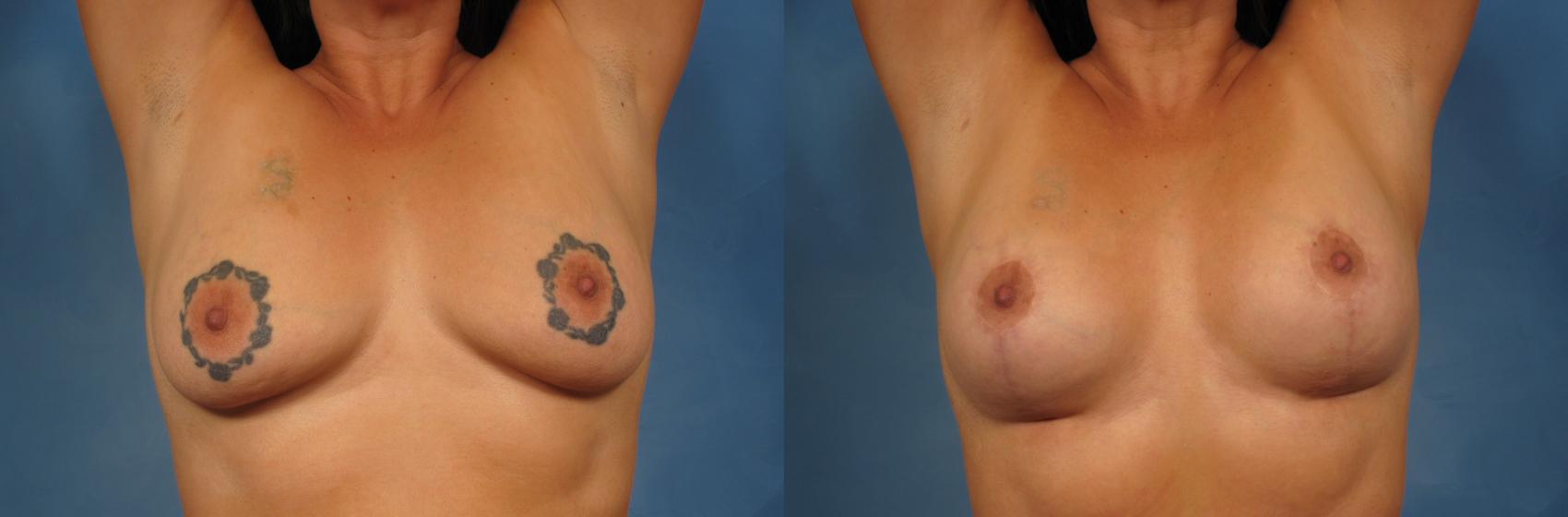 Before & After Breast Lift Case 239 View #2 View in Naples and Ft. Myers, FL