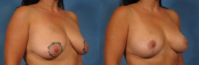 Before & After Breast Lift Case 239 View #3 View in Naples and Ft. Myers, FL