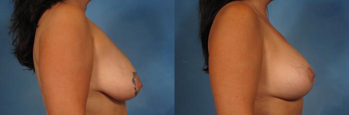Before & After Breast Lift Case 239 View #4 View in Naples and Ft. Myers, FL