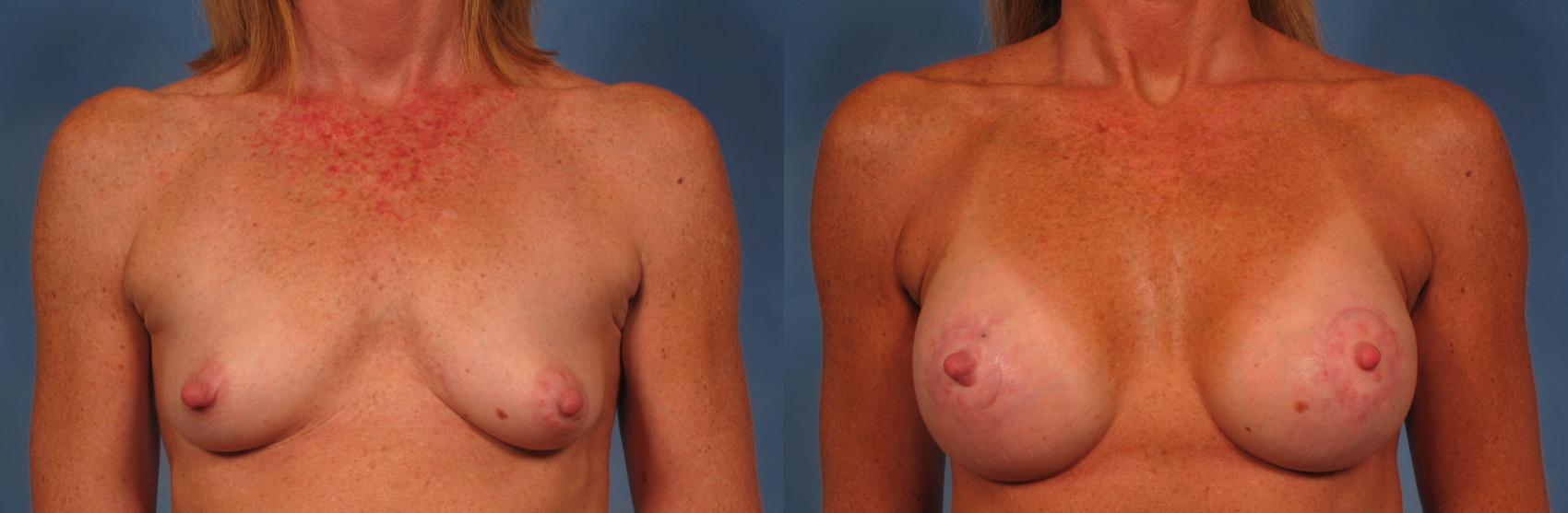 Before & After Breast Lift Case 272 View #1 View in Naples and Ft. Myers, FL