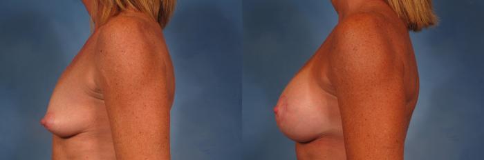 Before & After Breast Lift Case 272 View #2 View in Naples and Ft. Myers, FL