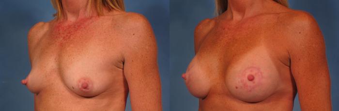 Before & After Breast Lift Case 272 View #3 View in Naples and Ft. Myers, FL