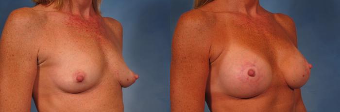 Before & After Breast Lift Case 272 View #4 View in Naples and Ft. Myers, FL