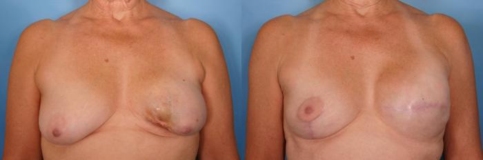 Before & After Breast Lift Case 34 View #1 View in Naples and Ft. Myers, FL