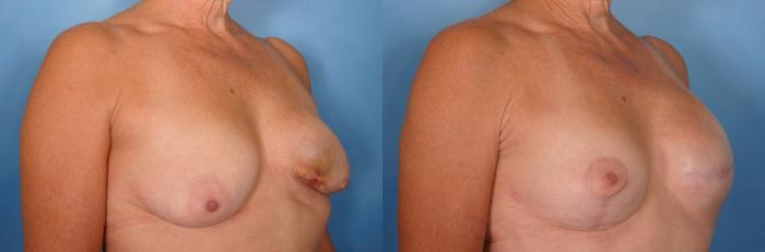 Before & After Breast Lift Case 34 View #2 View in Naples and Ft. Myers, FL