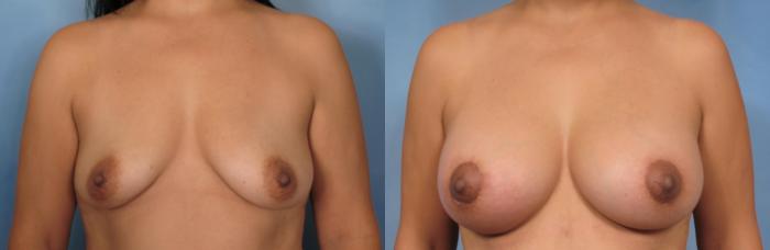 Before & After Breast Lift Case 93 View #1 View in Naples and Ft. Myers, FL