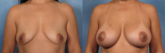 Before & After Breast Lift Case 93 View #2 View in Naples and Ft. Myers, FL