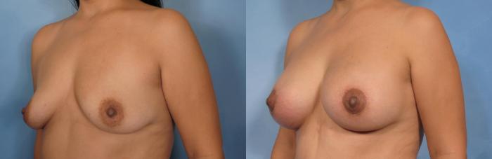 Before & After Breast Lift Case 93 View #3 View in Naples and Ft. Myers, FL