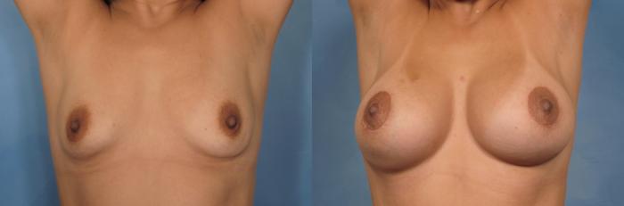 Before & After Breast Lift Case 93 View #6 View in Naples and Ft. Myers, FL