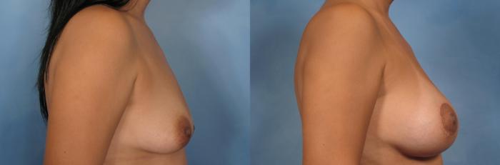 Before & After Breast Lift Case 93 View #7 View in Naples and Ft. Myers, FL