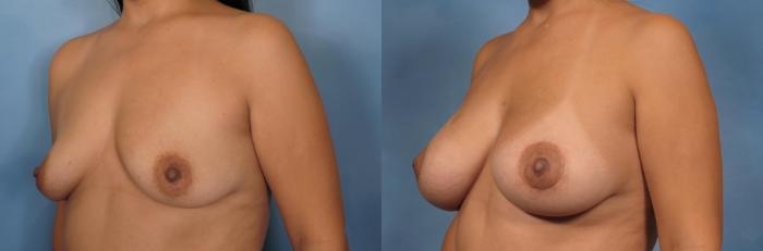 Before & After Breast Lift Case 93 View #8 View in Naples and Ft. Myers, FL