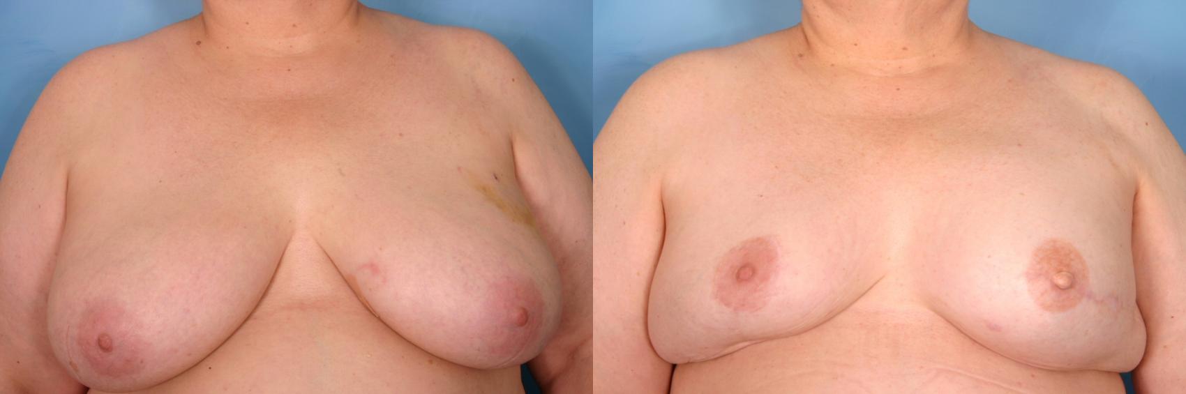 乳房重建前后病例53视图1在那不勒斯和佛罗里达州迈尔斯堡的视图