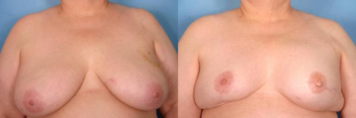 Before & After Breast Reconstruction Case 53 View #1 View in Naples and Ft. Myers, FL