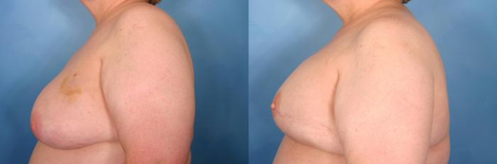 Before & After Breast Reconstruction Case 53 View #2 View in Naples and Ft. Myers, FL