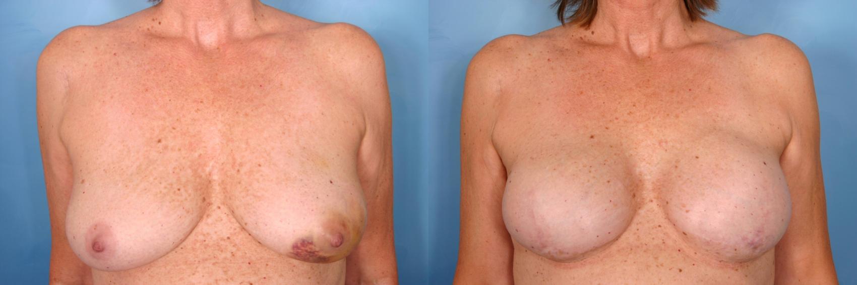 Before & After Breast Reconstruction Case 63 View #1 View in Naples, FL