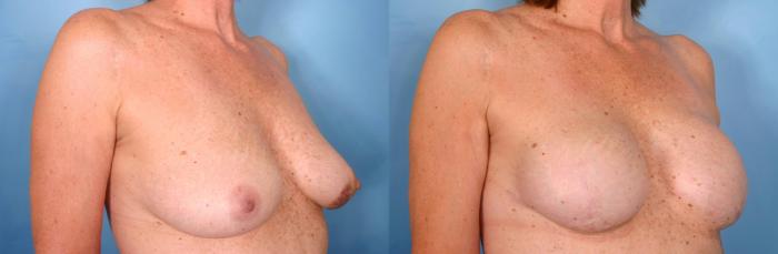 Before & After Breast Reconstruction Case 63 View #2 View in Naples and Ft. Myers, FL