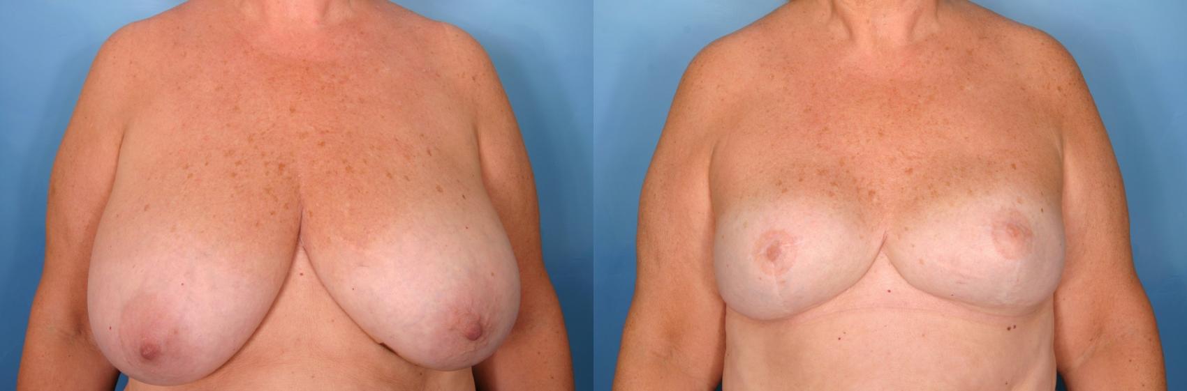 Before & After Breast Reconstruction Case 85 View #1 View in Naples and Ft. Myers, FL