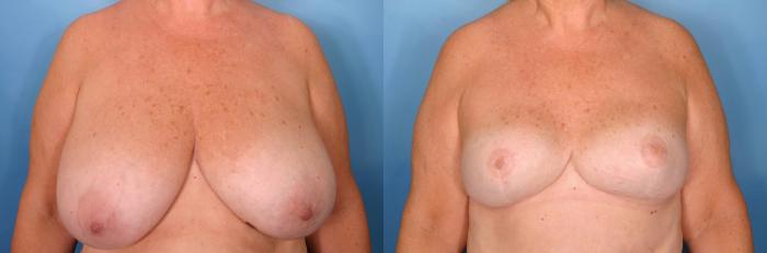 Before & After Breast Reconstruction Case 85 View #1 View in Naples and Ft. Myers, FL