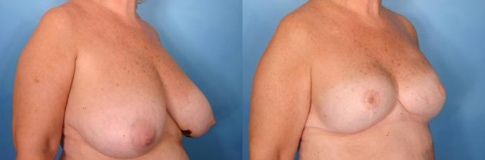Before & After Breast Reconstruction Case 85 View #2 View in Naples and Ft. Myers, FL