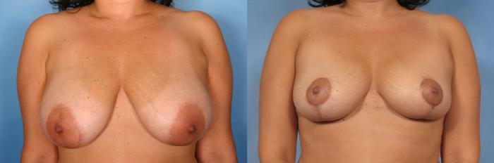 Before & After Breast Reduction Case 101 View #1 View in Naples and Ft. Myers, FL