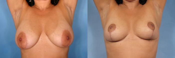 Before & After Breast Reduction Case 101 View #2 View in Naples and Ft. Myers, FL