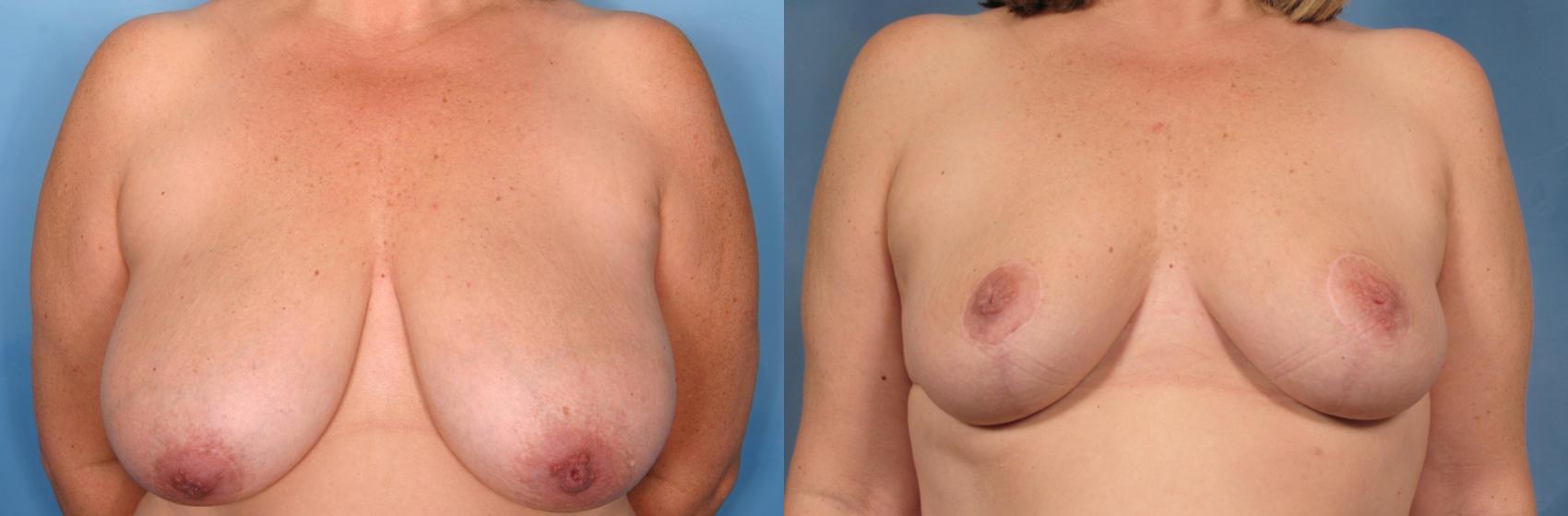 Before & After Breast Reduction Case 102 View #1 View in Naples and Ft. Myers, FL