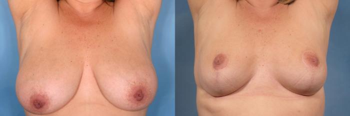 Before & After Breast Reduction Case 102 View #2 View in Naples and Ft. Myers, FL