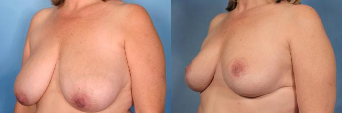 Before & After Breast Reduction Case 102 View #3 View in Naples and Ft. Myers, FL