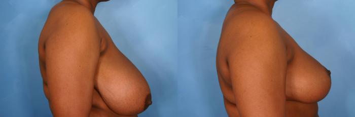 Before & After Breast Reduction Case 33 View #2 View in Naples and Ft. Myers, FL