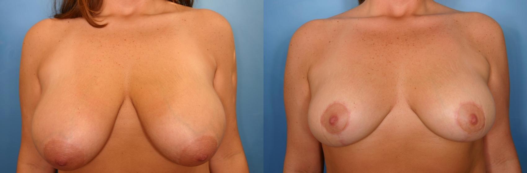 Before & After Breast Reduction Case 43 View #1 View in Naples and Ft. Myers, FL