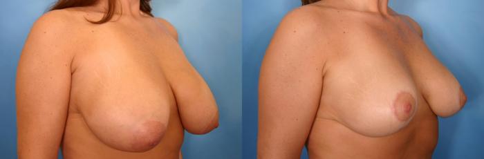 Before & After Breast Reduction Case 43 View #2 View in Naples and Ft. Myers, FL