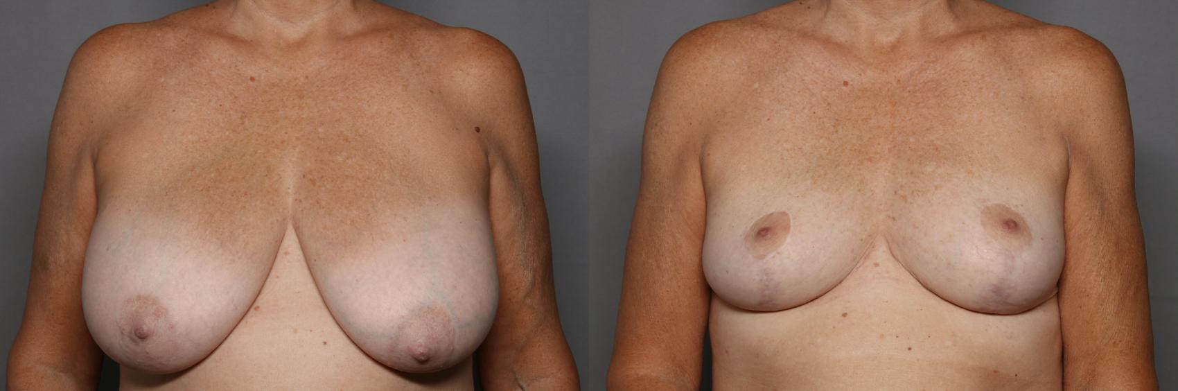 Before Breast Reduction in Naples, Florida, Front View