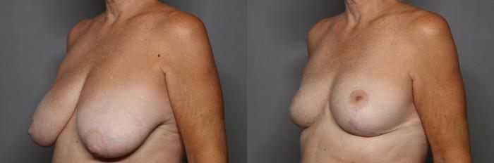 Before  Breast Reduction in Naples, Florida, Left Oblique View