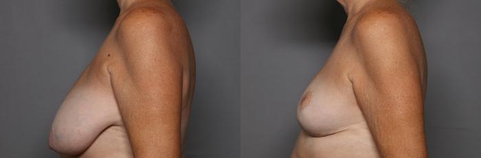 Before Breast Reduction in Naples, Florida, Left Side View