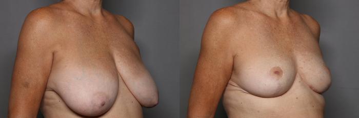 Before Breast Reduction in Naples, Florida, Right Oblique View