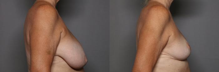 Before Breast Reduction in Naples, Florida, Right Side View