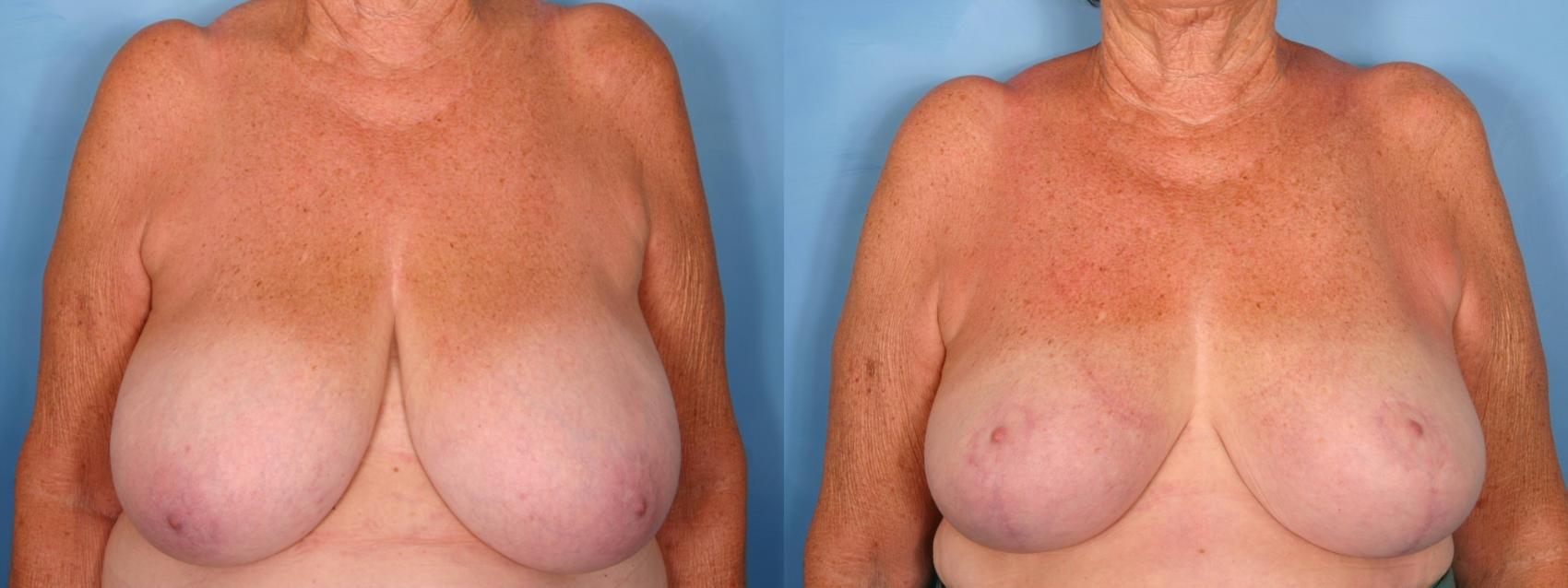 Before & After Breast Reduction Case 50 View #1 View in Naples and Ft. Myers, FL