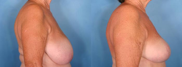 Before & After Breast Reduction Case 50 View #2 View in Naples and Ft. Myers, FL