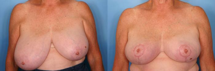 Before & After Breast Reduction Case 59 View #1 View in Naples and Ft. Myers, FL