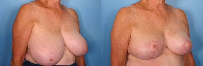 Before & After Breast Reduction Case 59 View #2 View in Naples and Ft. Myers, FL