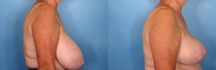 Before & After Breast Reduction Case 59 View #3 View in Naples and Ft. Myers, FL