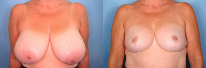 Before & After Breast Reduction Case 65 View #1 View in Naples and Ft. Myers, FL