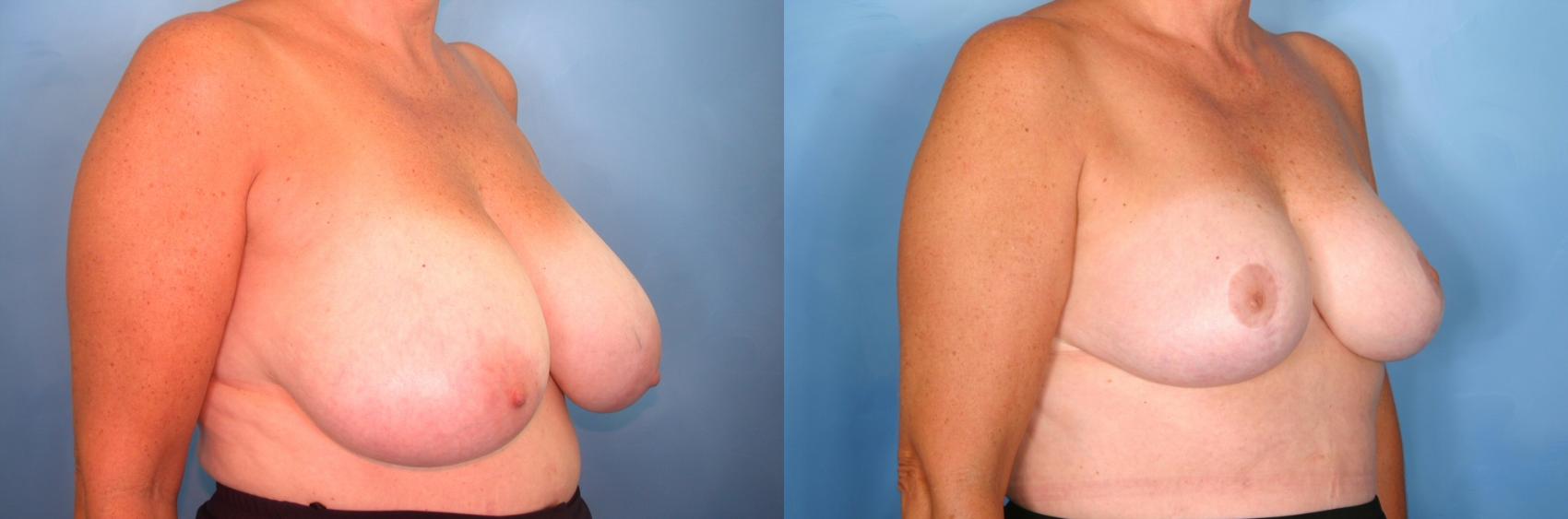 Before & After Breast Reduction Case 65 View #2 View in Naples and Ft. Myers, FL