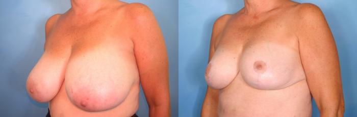Before & After Breast Reduction Case 65 View #3 View in Naples and Ft. Myers, FL