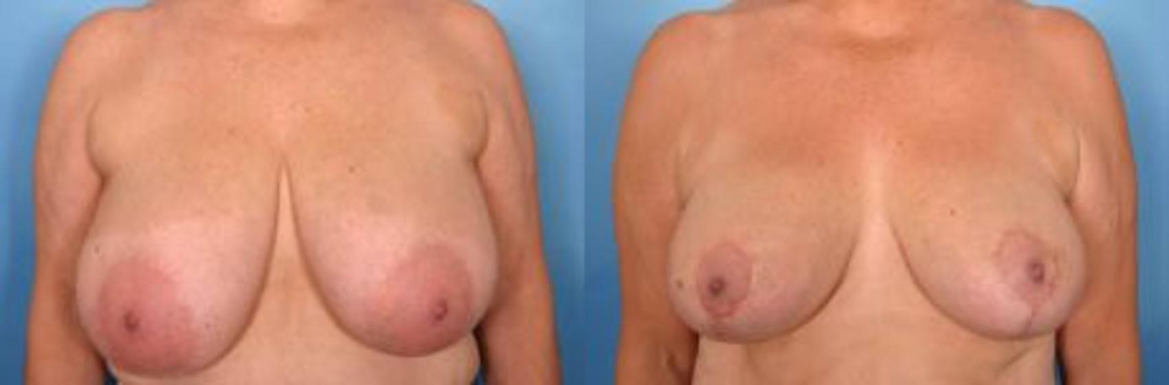 Before & After Breast Reduction Case 7 View #1 View in Naples and Ft. Myers, FL