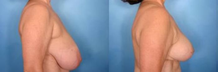 Before & After Breast Reduction Case 7 View #2 View in Naples and Ft. Myers, FL