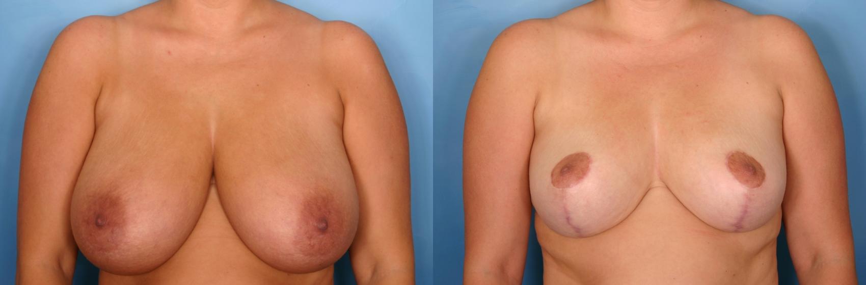 Before & After Breast Reduction Case 83 View #1 View in Naples and Ft. Myers, FL